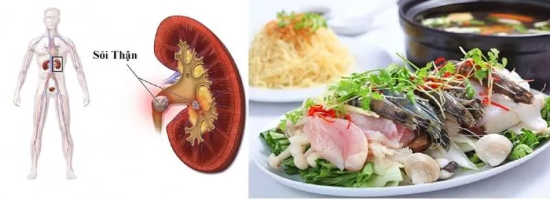 Bị Sỏi Thận Có Ăn Được Hải Sản Không? Nguy Cơ Và Chế Độ Dinh Dưỡng